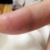 怎么预防患上瘙痒症