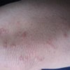 面部皮炎治疗需要注意什么事情