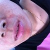 平常生活中应该如何防止皮炎的发生