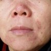 接触性皮炎给患者带来什么伤害