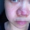 酒渣鼻的治疗的手法有什么