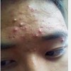 医生介绍造成痤疮的主要原因
