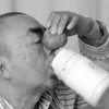 当心挤黑头挤出酒渣鼻
