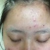 男性如何缓解面部痤疮