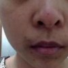 酒糟鼻的症状表现的具体介绍