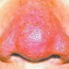 丘疹期的酒糟鼻的症状是什么