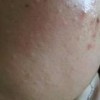 如何诊治痤疮痒呢