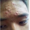 痤疮的治疗该怎么做