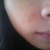 女生长痤疮怎么治疗