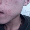 治疗疥疮的有效措施