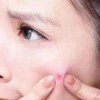 青春痘变得更加严重如何做