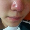 酒渣鼻乱用药到底多可怕