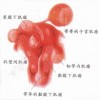 根据病理外阴白斑如何分类