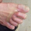 手足癣易患人群有哪些