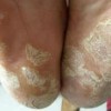 足癣可以怎样来诊断
