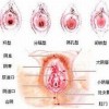 外阴白斑与慢性营养不良症有什么关系