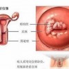 外阴白斑患者保健常识有哪些