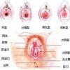 外阴白斑患者要有良好的生活作息