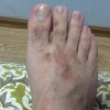 手足癣的诊断常识与要点