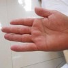 手足癣患者如何预防病情加重