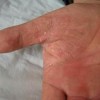 应该如何有效预防手足癣呢