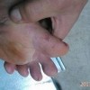 患上手足癣的内因和外因的因素