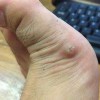 挖鸡眼应该有哪些要注意问题
