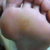 鸡眼患者的护理办法有什么
