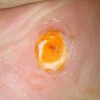 鸡眼患者怎样护理患区