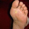 脚上长了鸡眼要如何护理