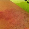 专家详解早期性病淋巴肉芽肿特点