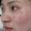 青春期预防黄褐斑怎么做