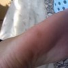 鸡眼和胼胝差异是什么