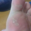 发生鸡眼会造成传染吗