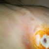 漫谈脚上长鸡眼的诱发条件