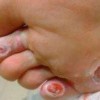 鸡眼爱上你的病因有什么