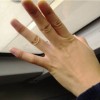长鸡眼原因是什么