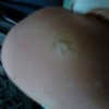 鸡眼主要是怎么样引起的