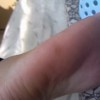 脚上突然长鸡眼是哪些因素