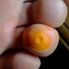 发生鸡眼会有传染的机会吗
