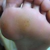 大家说的鸡眼是什么意思