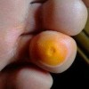 鸡眼对患者有什么危害