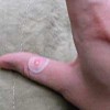 专家讲解鸡眼的症状