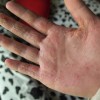 手癣会不会和其他癣病有传染的作用