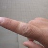 手癣会引发什么危害