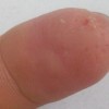 手癣患者尽量不要下厨房
