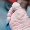 糖尿病患者治疗鸡眼要求注意哪些