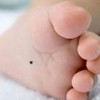 治疗晕痣先天性色素痣要及时