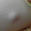 颅内脂肪瘤的病理与组织学特点如何