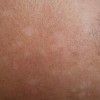 夏季怎样的预防花斑癣